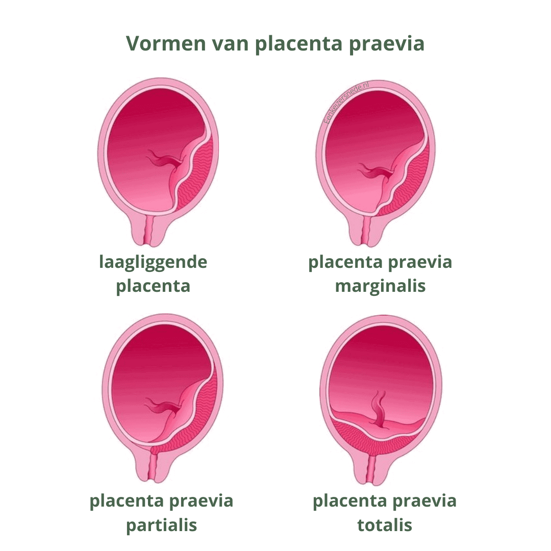 Placenta praevia Placenta praevia